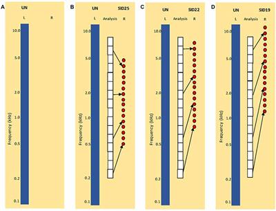 Effects of Training on Lateralization for Simulations of Cochlear Implants and Single-Sided Deafness